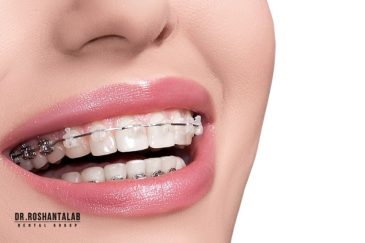 پوسیدگی دندان در ارتودنسی