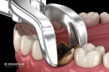 کاشت ایمپلنت 3 ماه بعد از کشیدن دندان