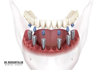چه تعداد ایمپلنت دندان نیاز دارم؟