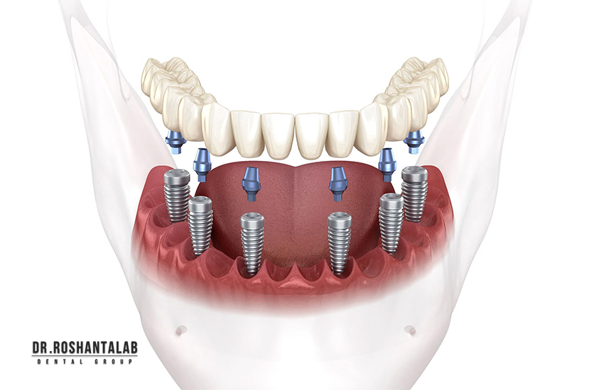 چه تعداد ایمپلنت دندان نیاز دارم؟