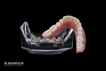 اوردنچر دندان (دنچرهای متکی بر پایه ایمپلنت)