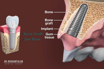 پیوند استخوان و کاربرد آن در ایمپلنت