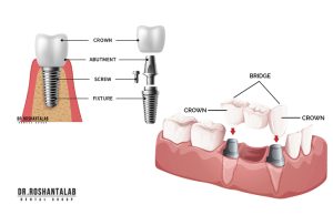 چرا ایمپلنت دندان بهترین راه‌حل است؟