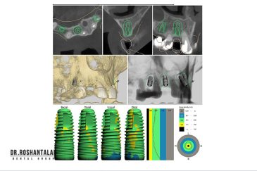 طراحی محل دقیق فیکسچر ایمپلنت