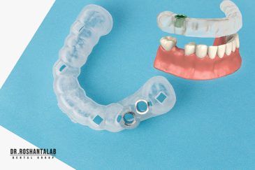 ایمپلنت دیجیتال: خداحافظی با جراحی سنتی در 5 مرحله کلیدی!