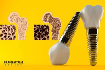 ایمپلنت برای افراد مبتلا به پوکی استخوان