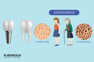 پوکی استخوان برای کاشت ایمپلنت دندان