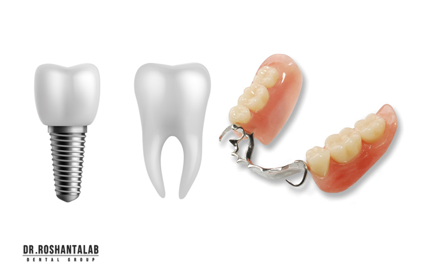 فلیپر دندان یا ایمپلنت؟ انتخابی حیاتی! 7 تفاوت کلیدی