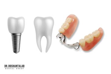 ایمپلنت دندان و مقایسه با دندان مصنوعی و بریج