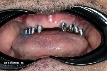 زمان جوش خوردن ایمپلنت دندان :4 روشی که ترمیم را سریع کنیم