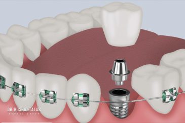 آیا ایمپلنت و ارتودنسی همزمان انجام می شود؟