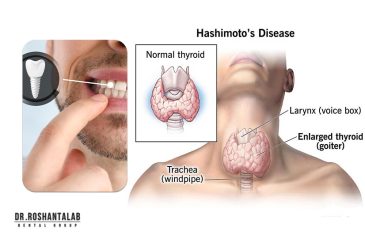 ایمپلنت دندان برای بیماران هاشیموتو