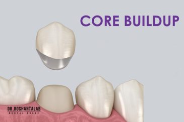 بیلدآپ دندان چیست؟