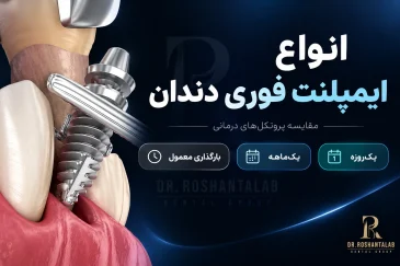 انواع ایمپلنت فوری دندان