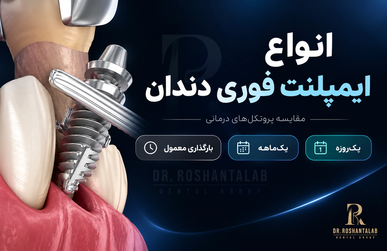 انواع ایمپلنت فوری دندان