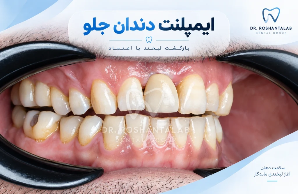 نمونه درمان واقعی ایمپلنت دندان جلو در کلینیک ایمپلنت دکتر روشن طلب
