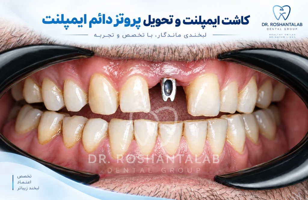 نمونه درمان واقعی ایمپلنت دندان جلو در کلینیک ایمپلنت دکتر روشن طلب