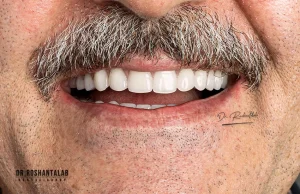 قیمت ایمپلنت دندان