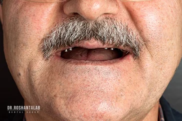 سخت‌ترین مرحله ایمپلنت دندان