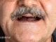 سخت‌ترین مرحله ایمپلنت دندان