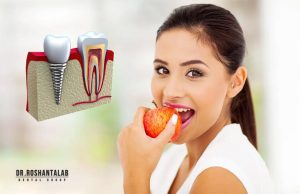 عمر ایمپلنت کره‌ ای : انواع، 7 تا از بهترین برندها و قیمت آن