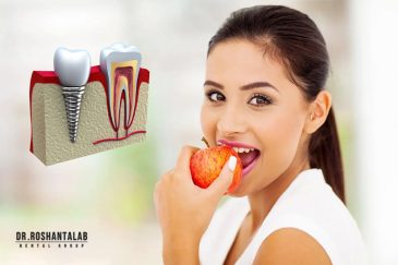 عمر ایمپلنت کره‌ ای : انواع، 7 تا از بهترین برندها و قیمت آن