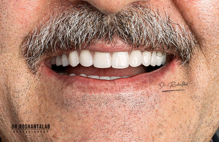 درمان ایمپلنت در کلینیک دکتر روشن طلب