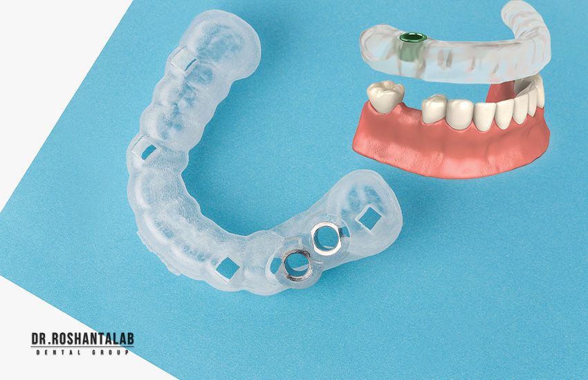 سرجیکال گاید: بهترین دکتر ایمپلنت دیجیتال در تهران