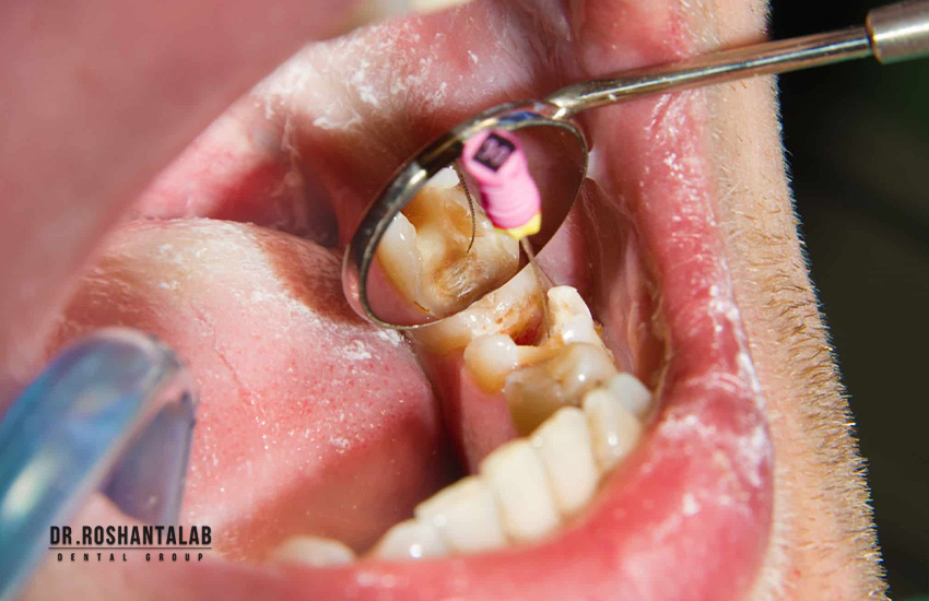 درمان ریشه دندان : کلینیک دندانپزشکی پاسارگاد