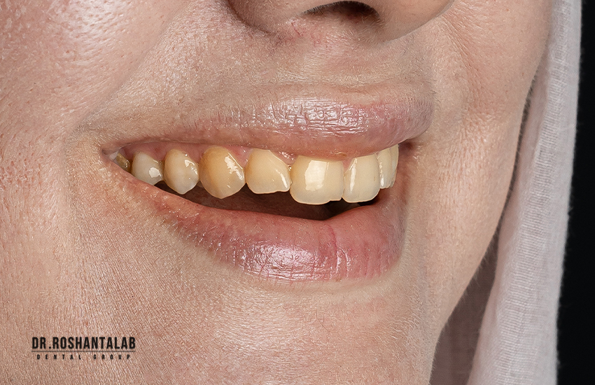 قبل از کامپوزیت دندان در کلینیک دندانپزشکی پاسارگاد