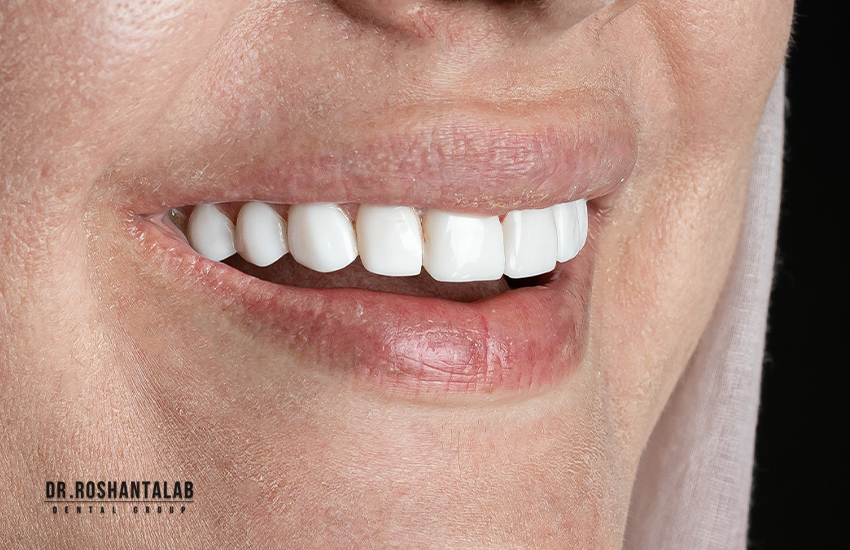 بعد از کامپوزیت دندان در کلینیک دندانپزشکی پاسارگاد