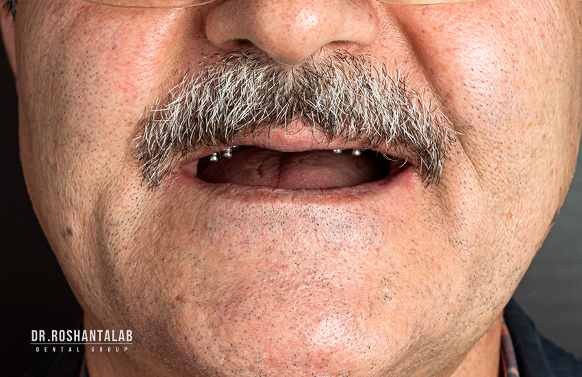 ایمپلنت دندان: اوردنچر در کلینیک دندانپزشکی پاسارگاد