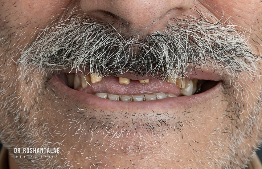 قبل از تحویل روکش دندان : کلینیک دندانپزشکی پاسارگاد