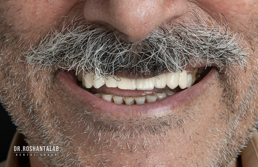 بعد از تحویل روکش دندان در کلینیک دندانپزشکی پاسارگاد