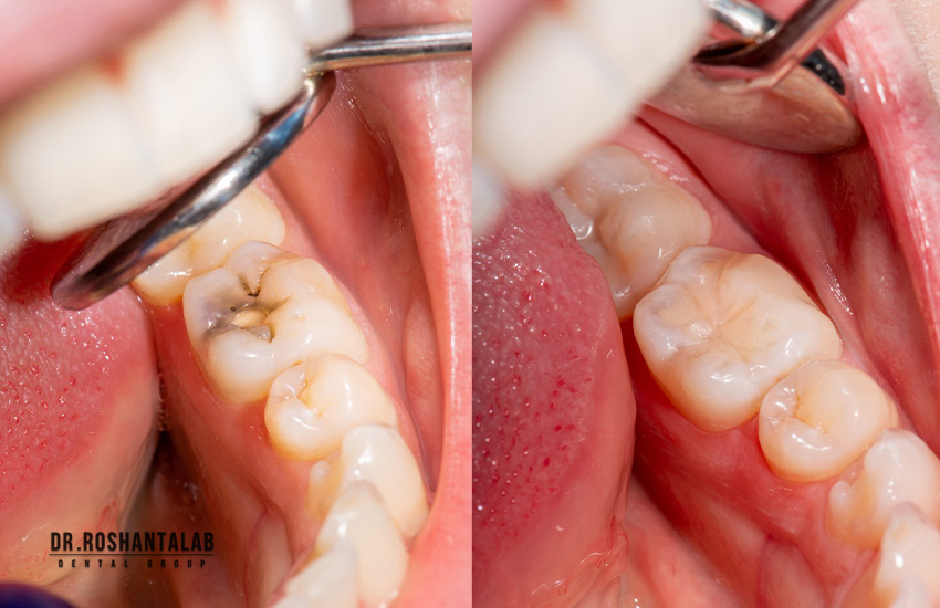 ترمیم دندان با کامپوزیت ونیر