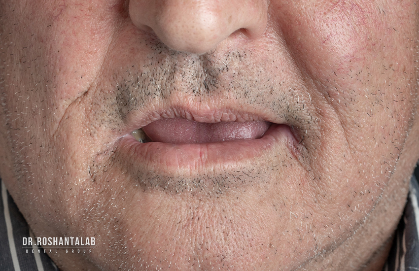 قبل از تحویل روکش ایمپلنت کل دهان در کلینیک دندانپزشکی پاسارگاد