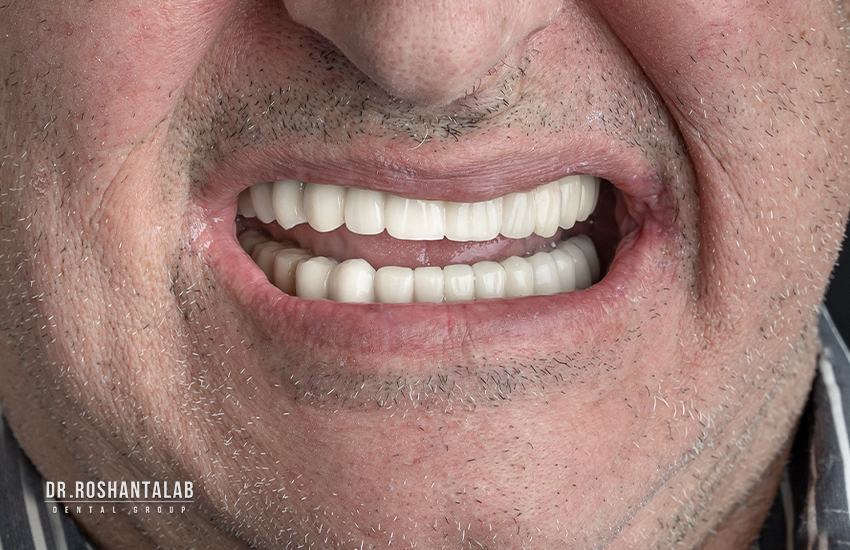 بعد از تحویل پروتز ایمپلنت کامل فک بالا و پایین در کلینیک دندانپزشکی پاسارگاد