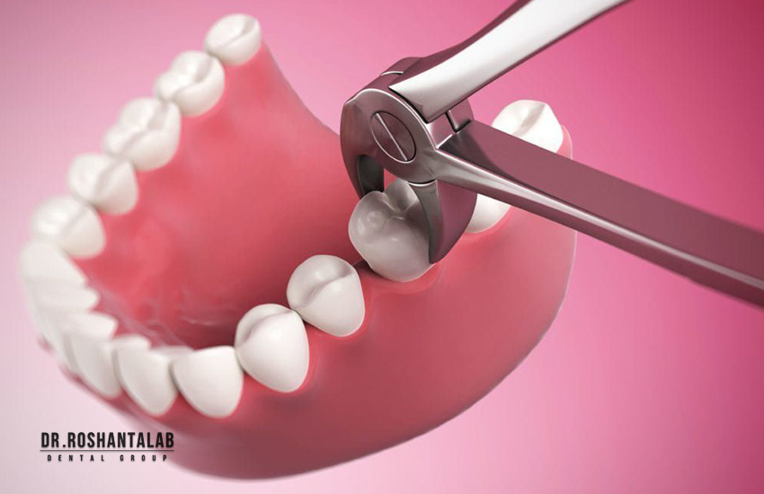 کشیدن دندان