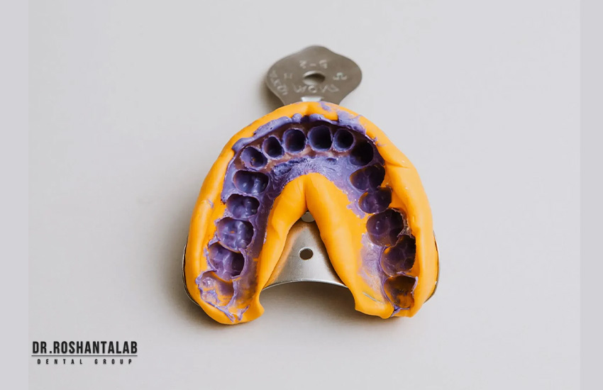 قالب گیری سنتی : ایمپلنت دندان چقدر طول می کشد