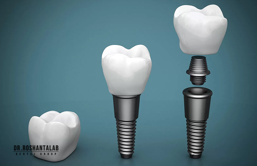 نصب هیلینگ اباتمنت