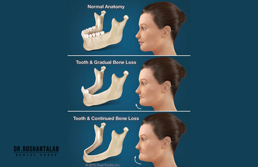دلایل تحلیل شدید استخوان