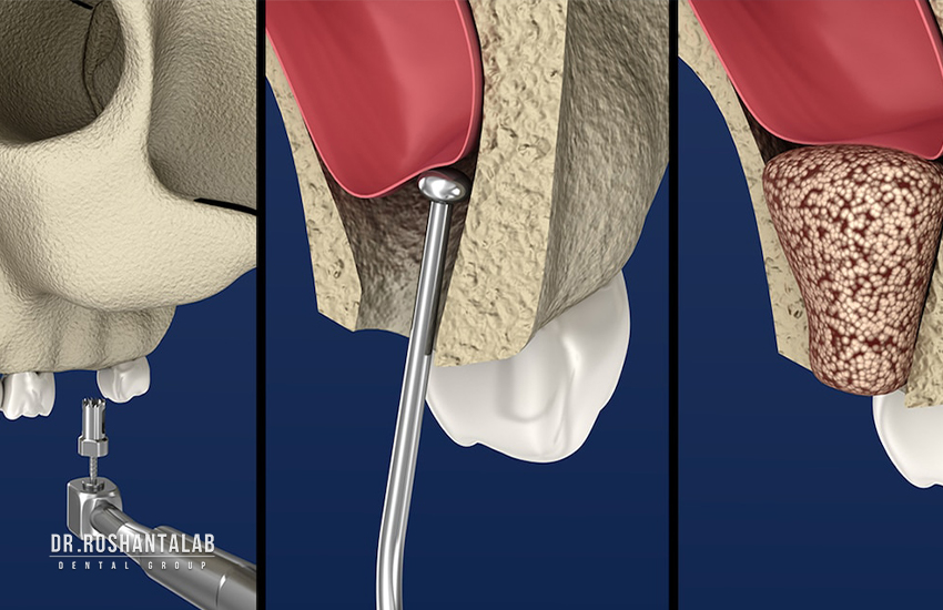 جراحی سینوس لیفت (Sinus Lift) ایمپلنت دندان چقدر طول می کشد؟