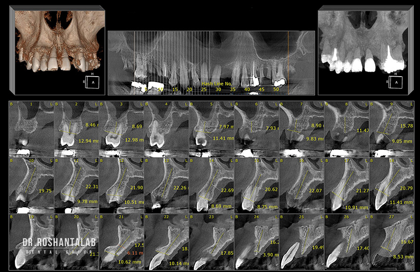  اسکن سه بعدی (CBCT)