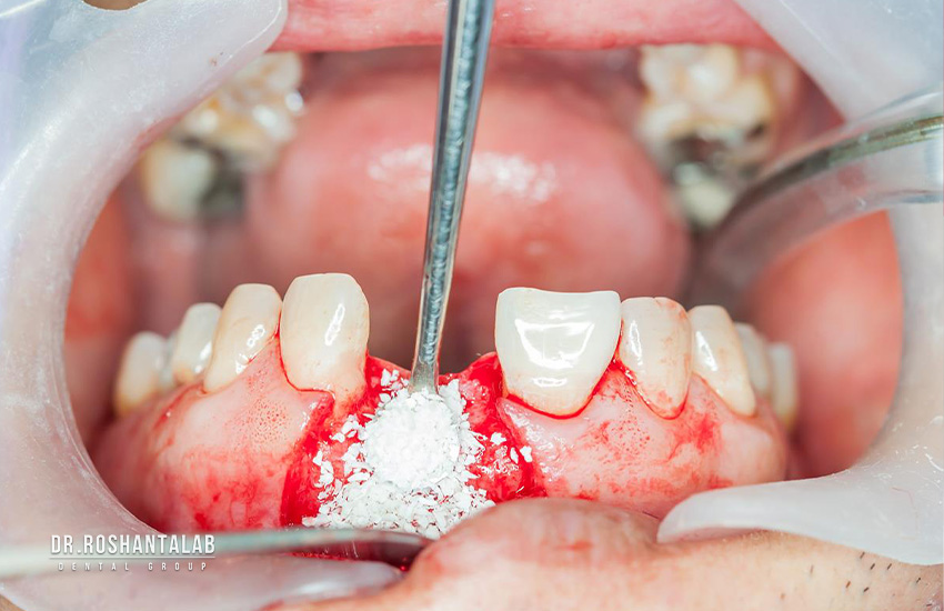 آیا پیوند استخوان برای ایمپلنت درد دارد؟