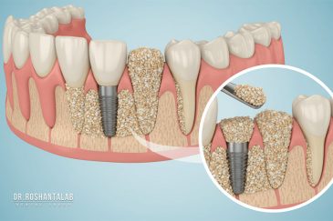 پیوند استخوان برای ایمپلنت؛ مراحل، درد و هزینه