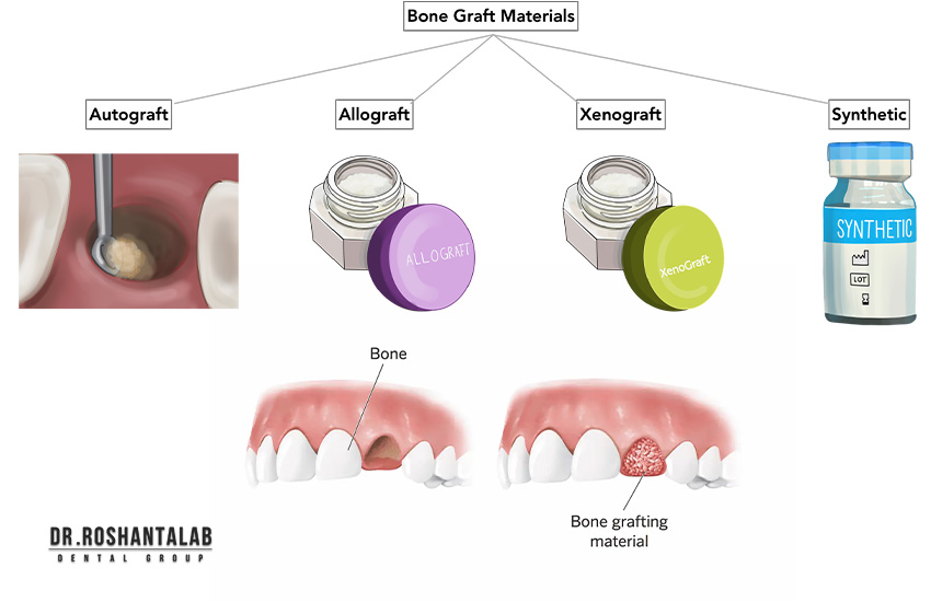 انواع مواد پیوند استخوان برای ایمپلنت