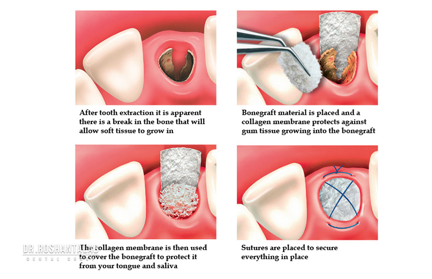 مراحل جراحی پیوند استخوان برای ایمپلنت دندان