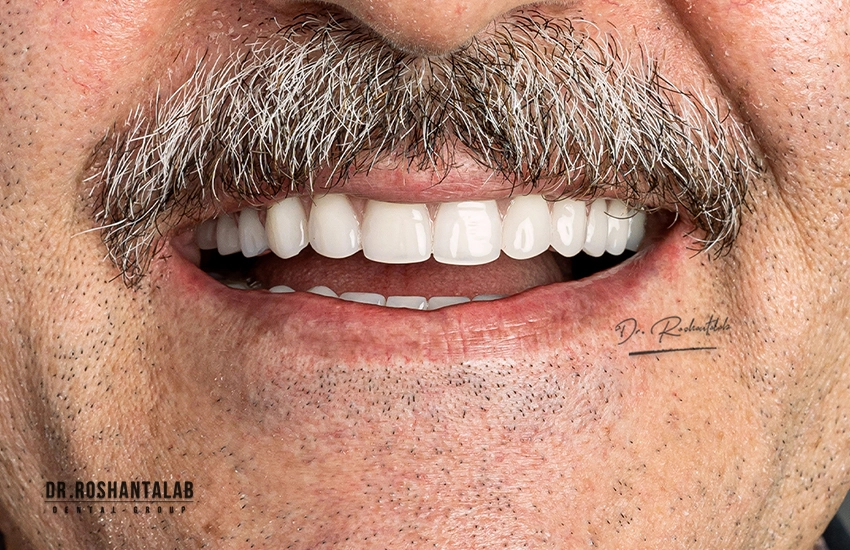 نمونه درمان اوردنچر برای بیمار واقعی کلینیک تخصصی ایمپلنت دکتر روشن طلب