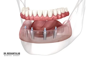 اوردنچر چیست؟ (صفر تا 100 مراحل بر پایه ایمپلنت + فیلم)