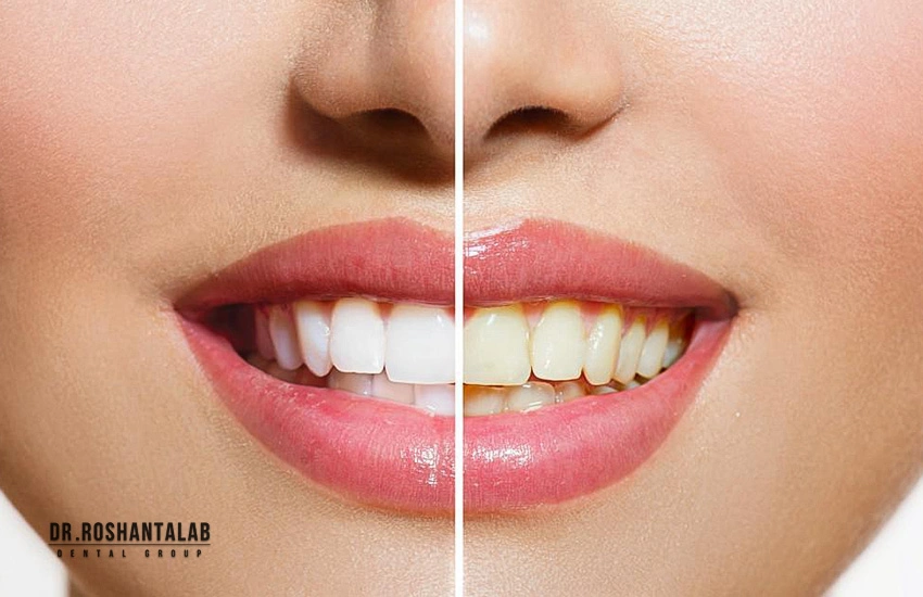 اصلاح طرح لبخند دیجیتال: اصلاح رنگ دندان بلیچینگ